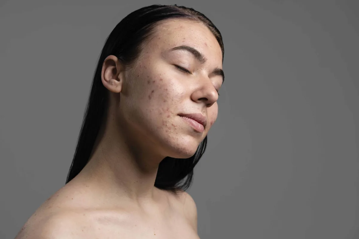 Fungal Acne