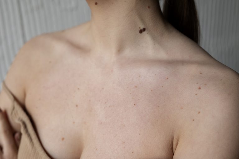 Body Acne: Everything You Need to Know from Causes to Treatment